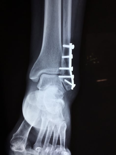 I Was Injured While Telecommuting…What Are My Rights?